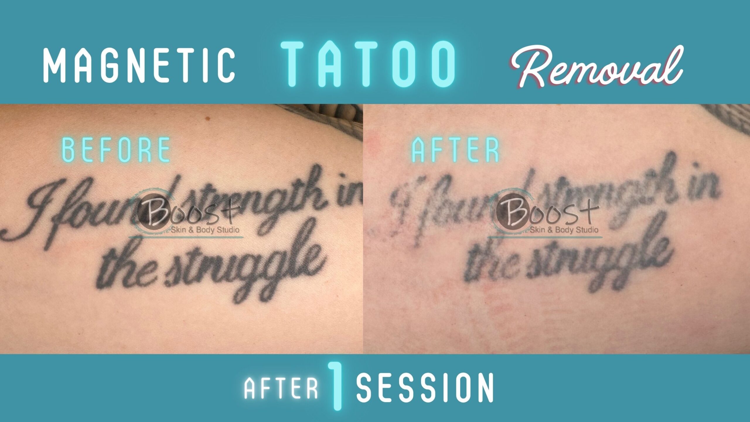 Magnetic Tattoo Removal | Boost Skin & Body Raleigh