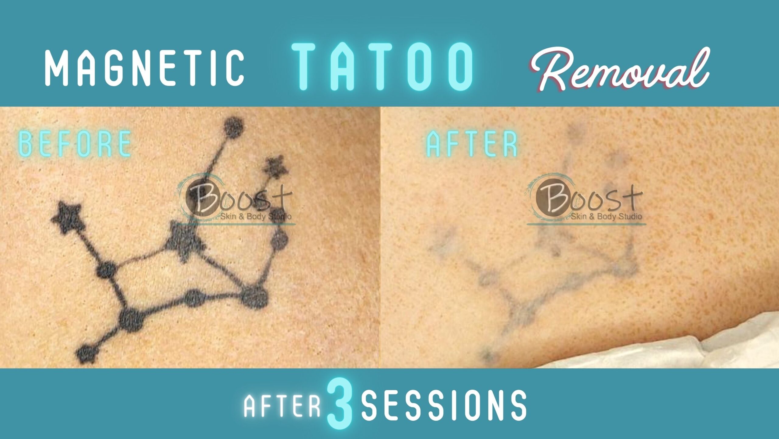 Magnetic Tattoo Removal | Boost Skin & Body Raleigh