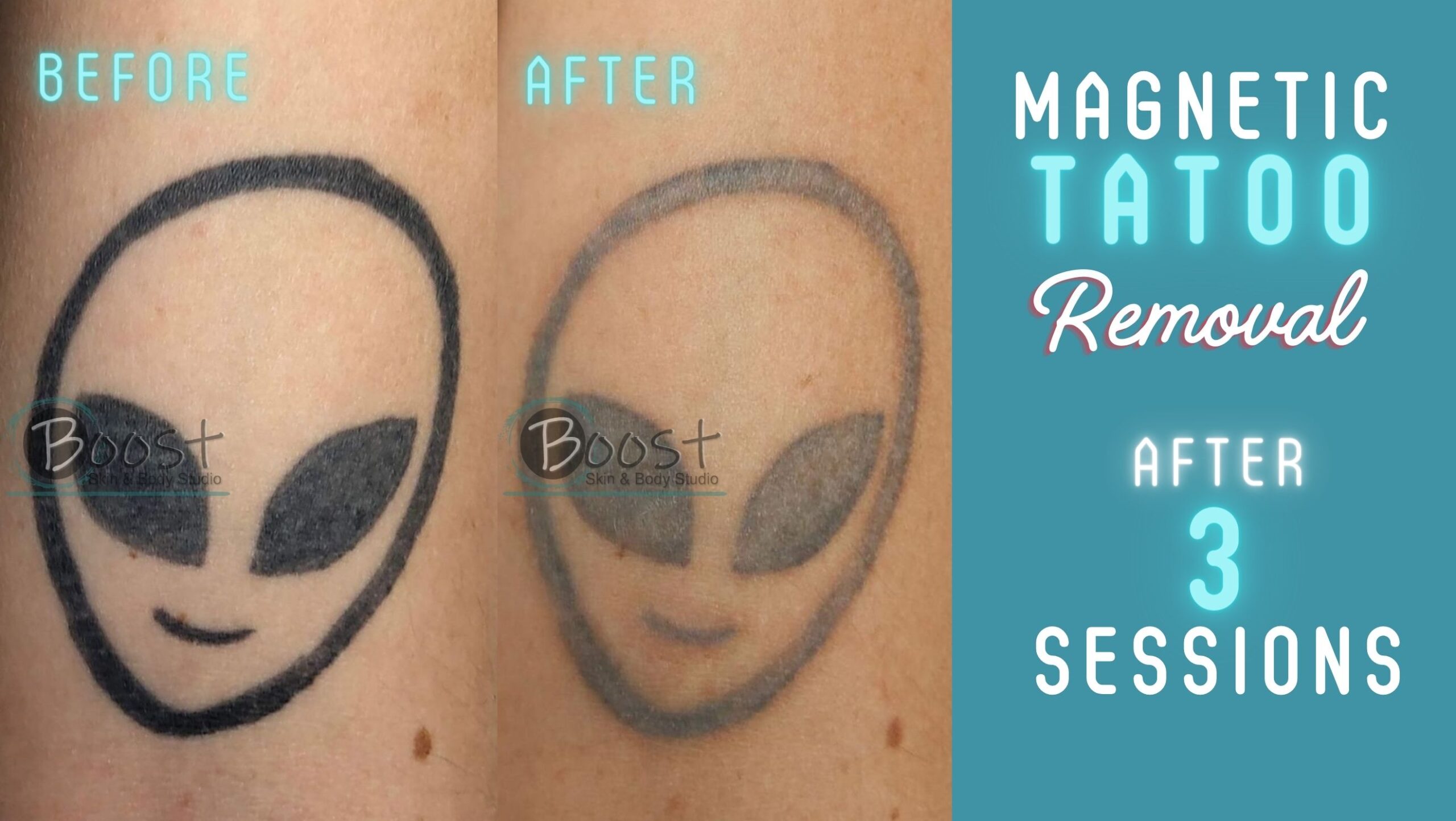 Magnetic Tattoo Removal | Boost Skin & Body Raleigh